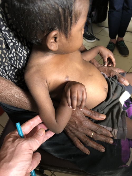 malnourished child in Madagascar